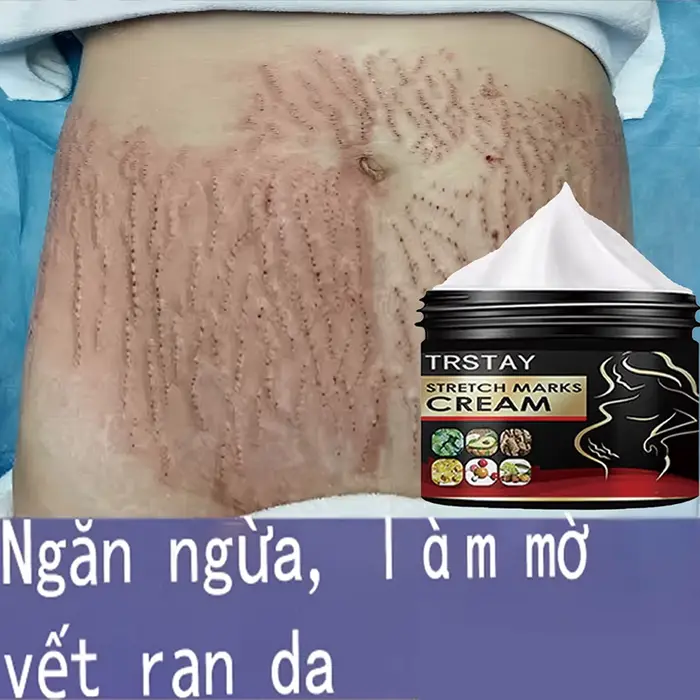 TRSTAY crème contre les vergetures pour la peau de grossesse reconstituer et réparer la Promotion de la croissance cellulaire soins de maternité Striae Gravidarum